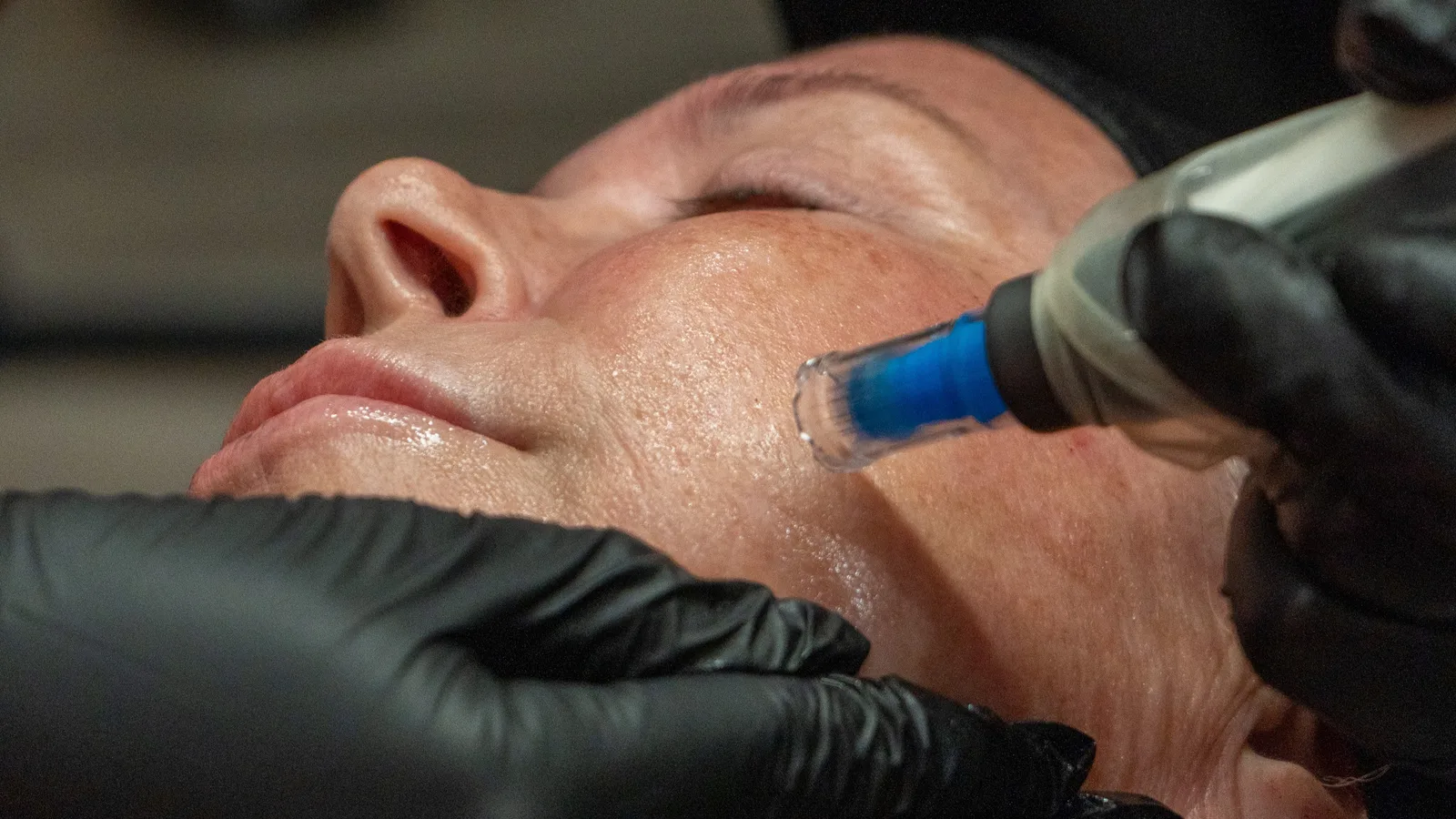 Client receiving a microneedling treatment and practicing skincare.