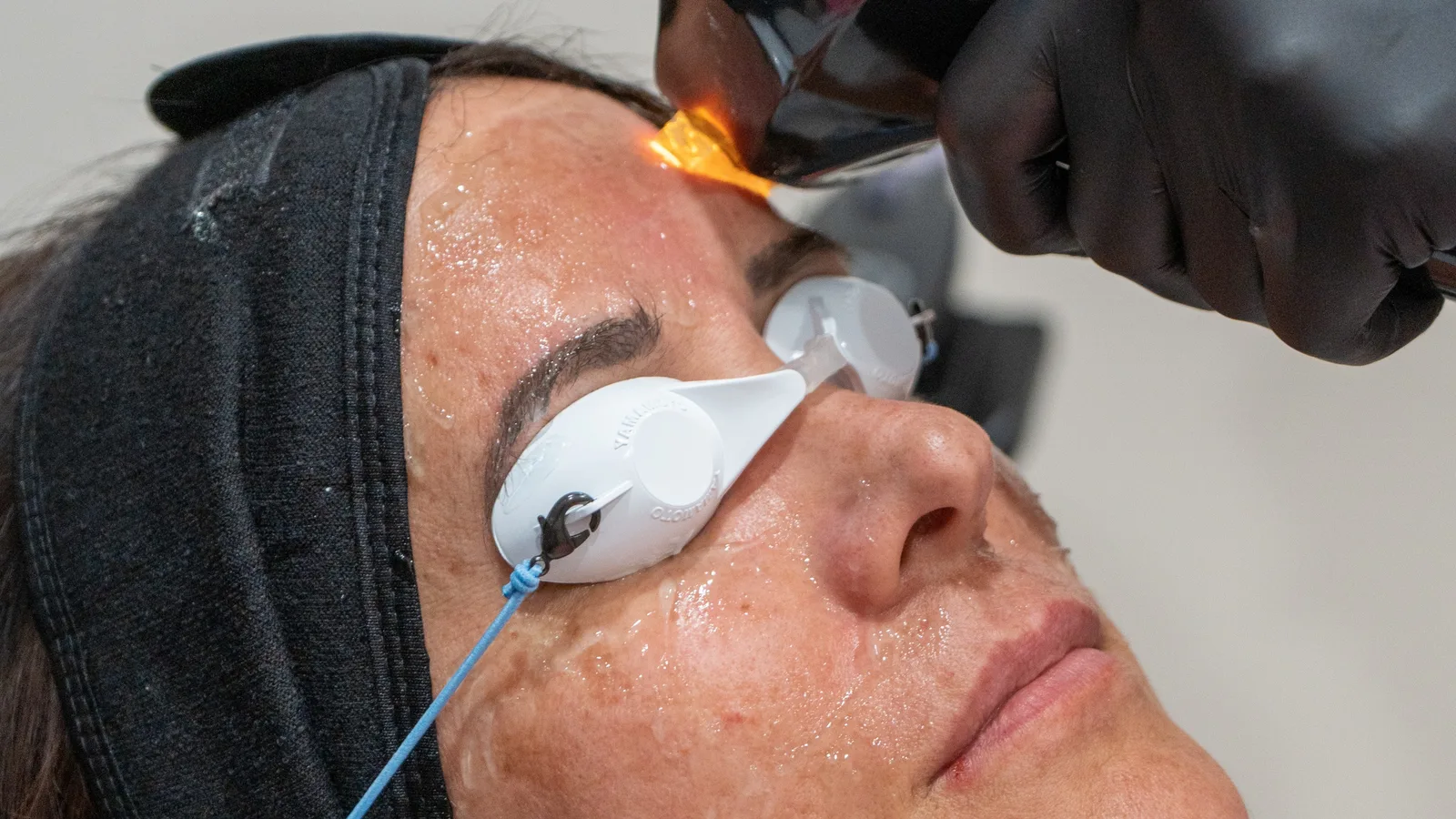 Client receiving lumecca treatment